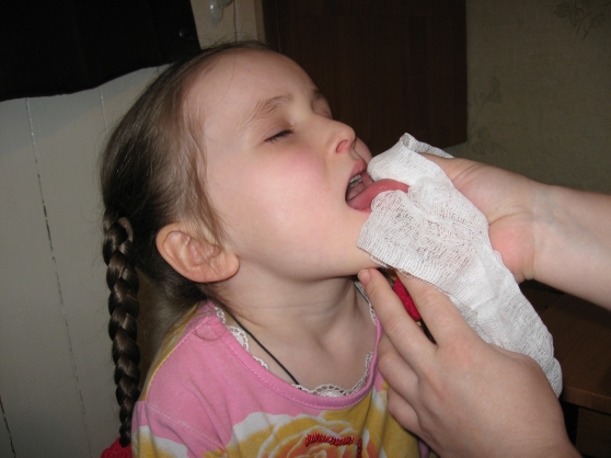 Массаж языка ребенку для развития речи при дизартрии