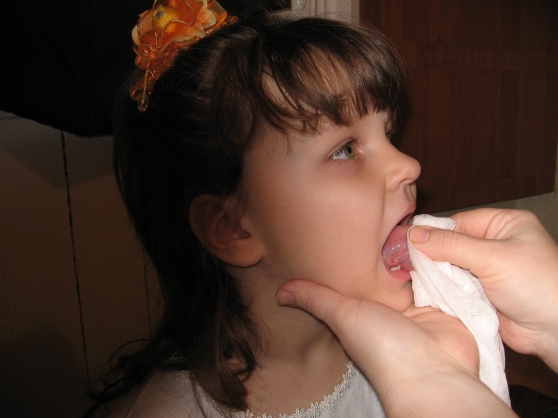 Массаж языка ребенку для развития речи при дизартрии